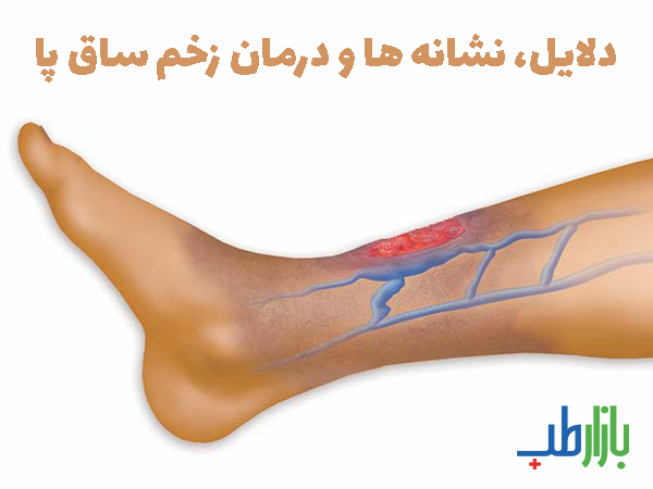 دلایل، نشانه ها و درمان زخم ساق پا