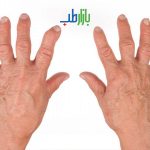 آرتریت روماتوئید