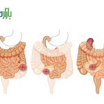 انواع استومی