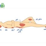 ریسک ابتلا به زخم بستر