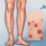 زخم واسکولیتی