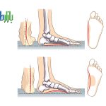 صافی کف پای کودک