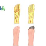 قانقاریای دیابتی