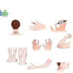 پوستی دیابت