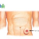 فتق اطراف استوما