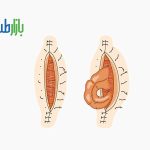 پارگی برش جراحی