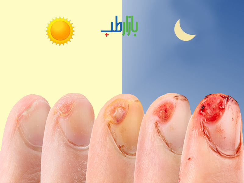 زخم روز