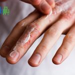 ترک خوردن