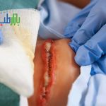 ترشحات زخم جراحی