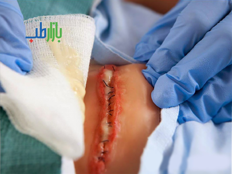 ترشحات زخم جراحی