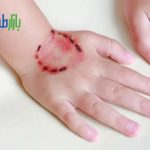 زخم گاز گرفتگی