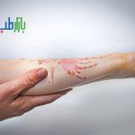 سوختگی حاد