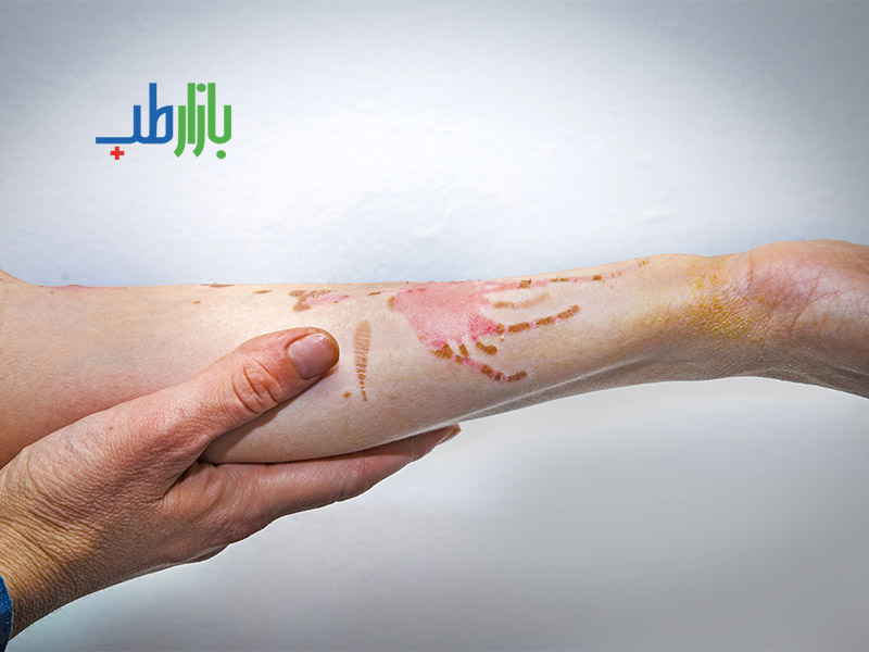 سوختگی حاد