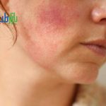 مویرگ های صورت