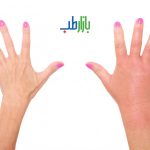 ورم انگشتان دست