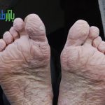 سندرم پا خندقی