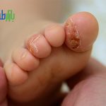 پسوریازیس نوزادان