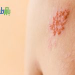 بیماری همراه با تاول
