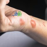 اسکار تاول