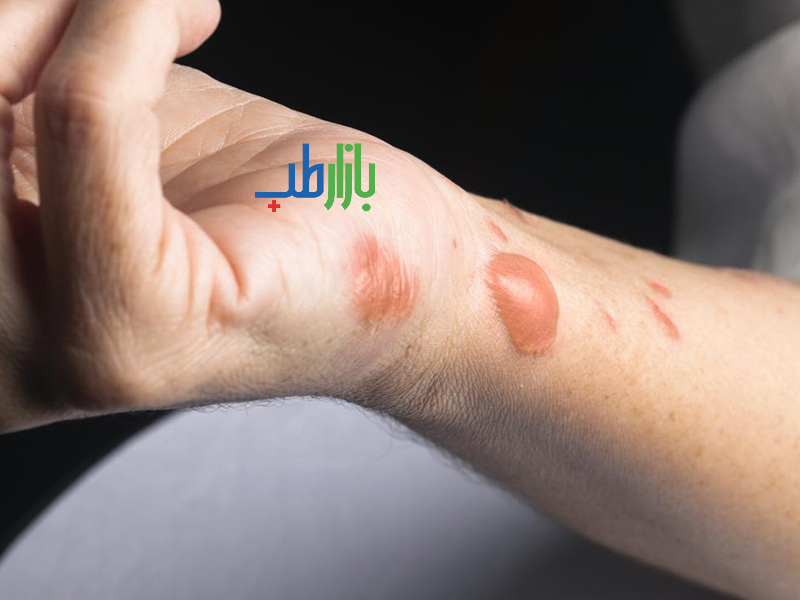 اسکار تاول