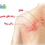 درمان خانگی زونا