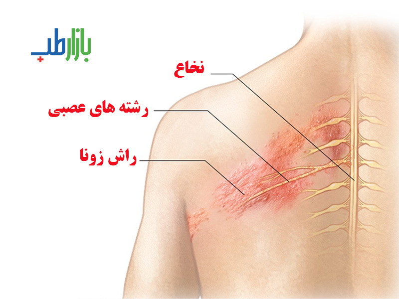 درمان خانگی زونا