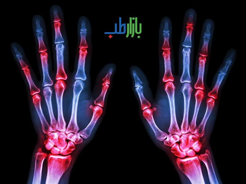 علائم آرتریت روماتوئید