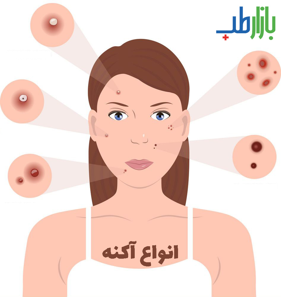 آکنه