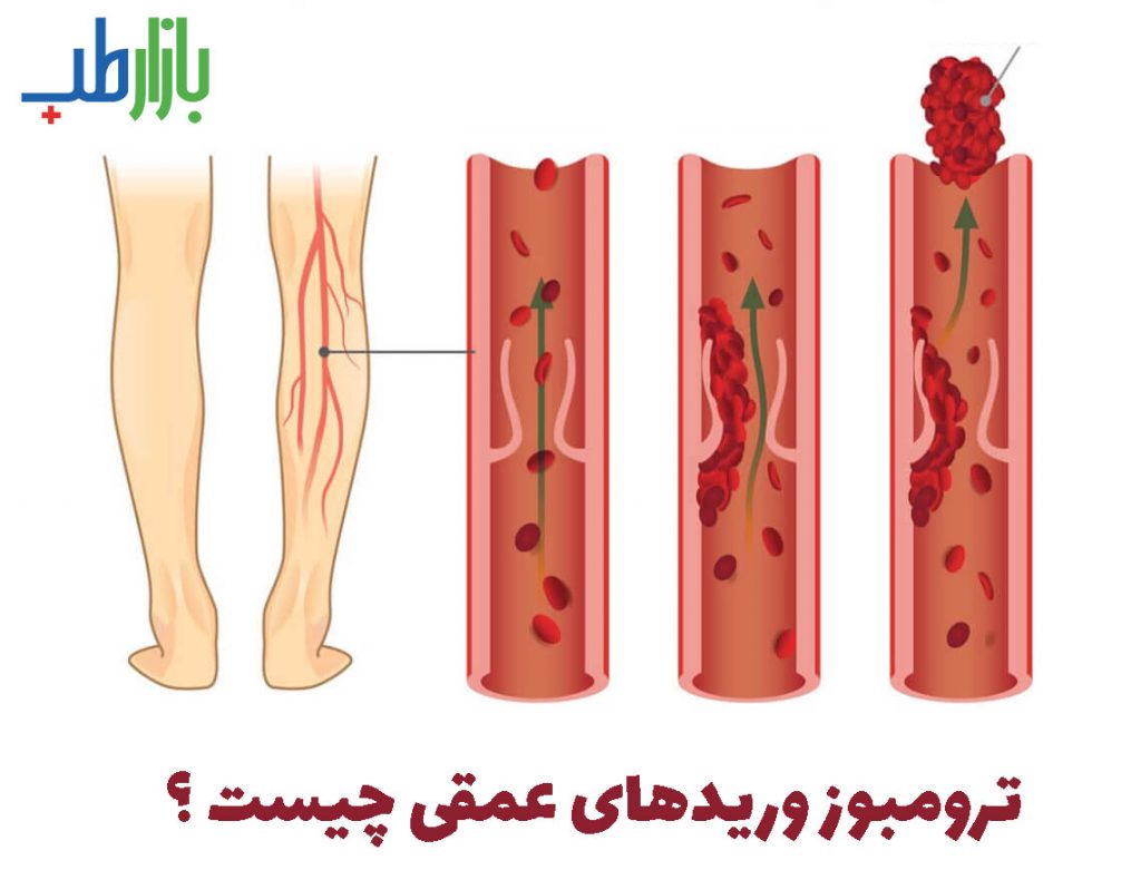 ترومبوز ورید های عمقی