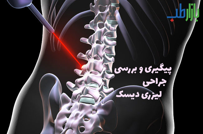 جراحی لیزری دیسک