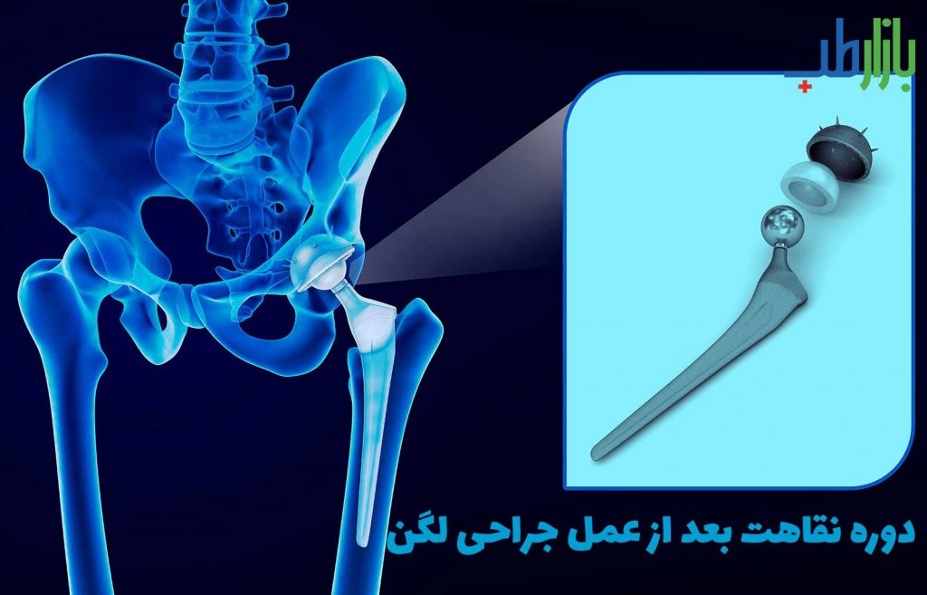 عمل جراحی لگن