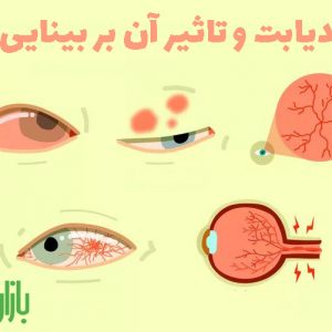 دیابت و تاثیر آن بر بینایی