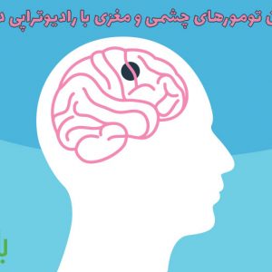 درمان تومورهای چشمی و مغزی با رادیوتراپی داخلی