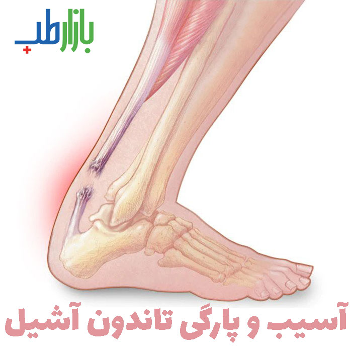 پارگی تاندون آشیل
