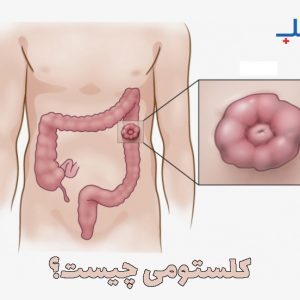 کلستومی چیست؟