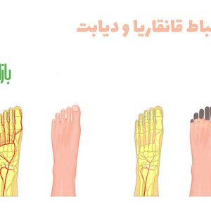 ارتباط قانقاریا و دیابت