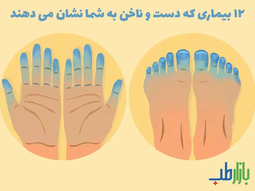 علایم بیماری در دست و ناخن
