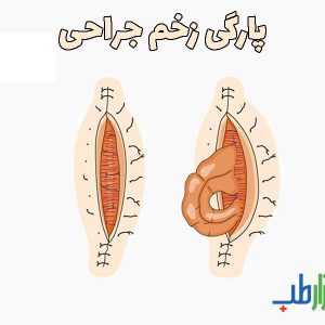 پارگی زخم جراحی