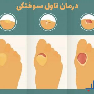 درمان تاول سوختگی