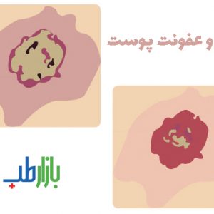 زخم و عفونت پوست