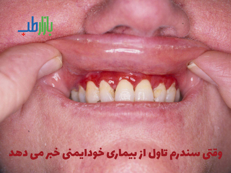 سندروم تاول و بیماری خود ایمنی