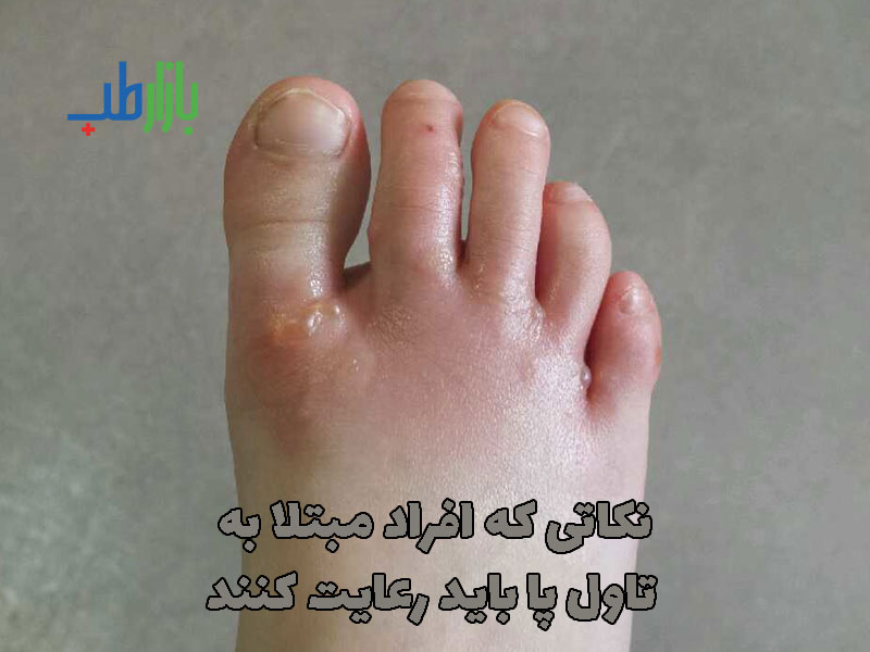 تاول پا