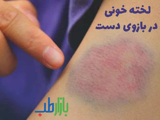 لخته خونی