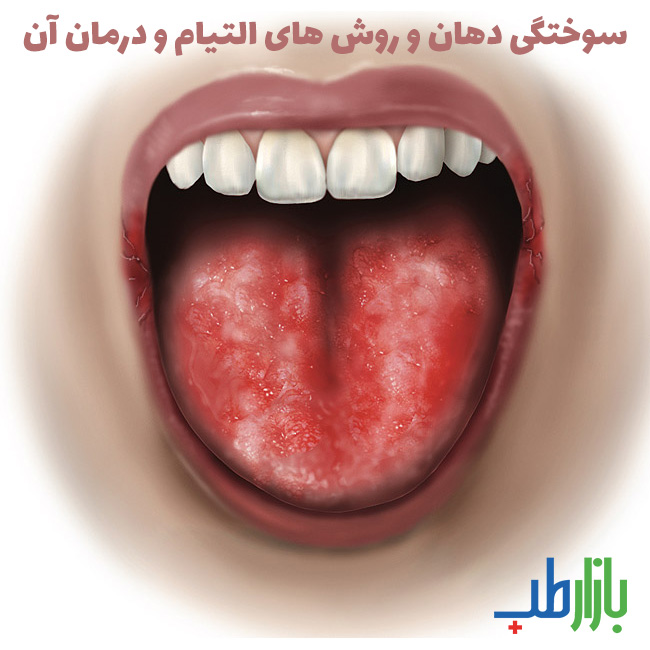 درمان سوختگی دهان