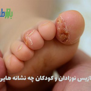 پسوریازیس نوزادان