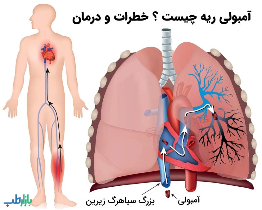 آمبولی ریه چیست