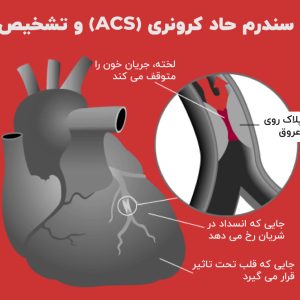 علائم سندرم حاد کرونری (ACS) و تشخیص آن