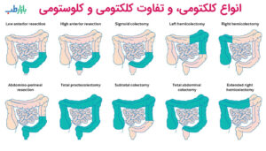 انواع کولکتومی