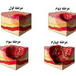 زخم بستر