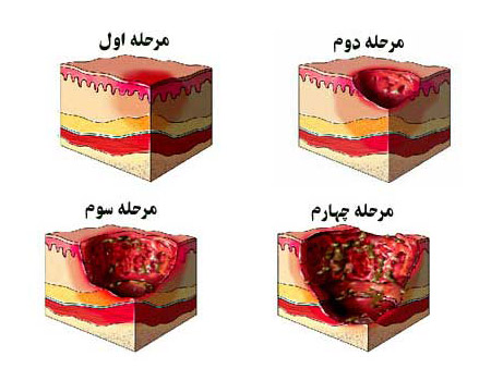 زخم بستر